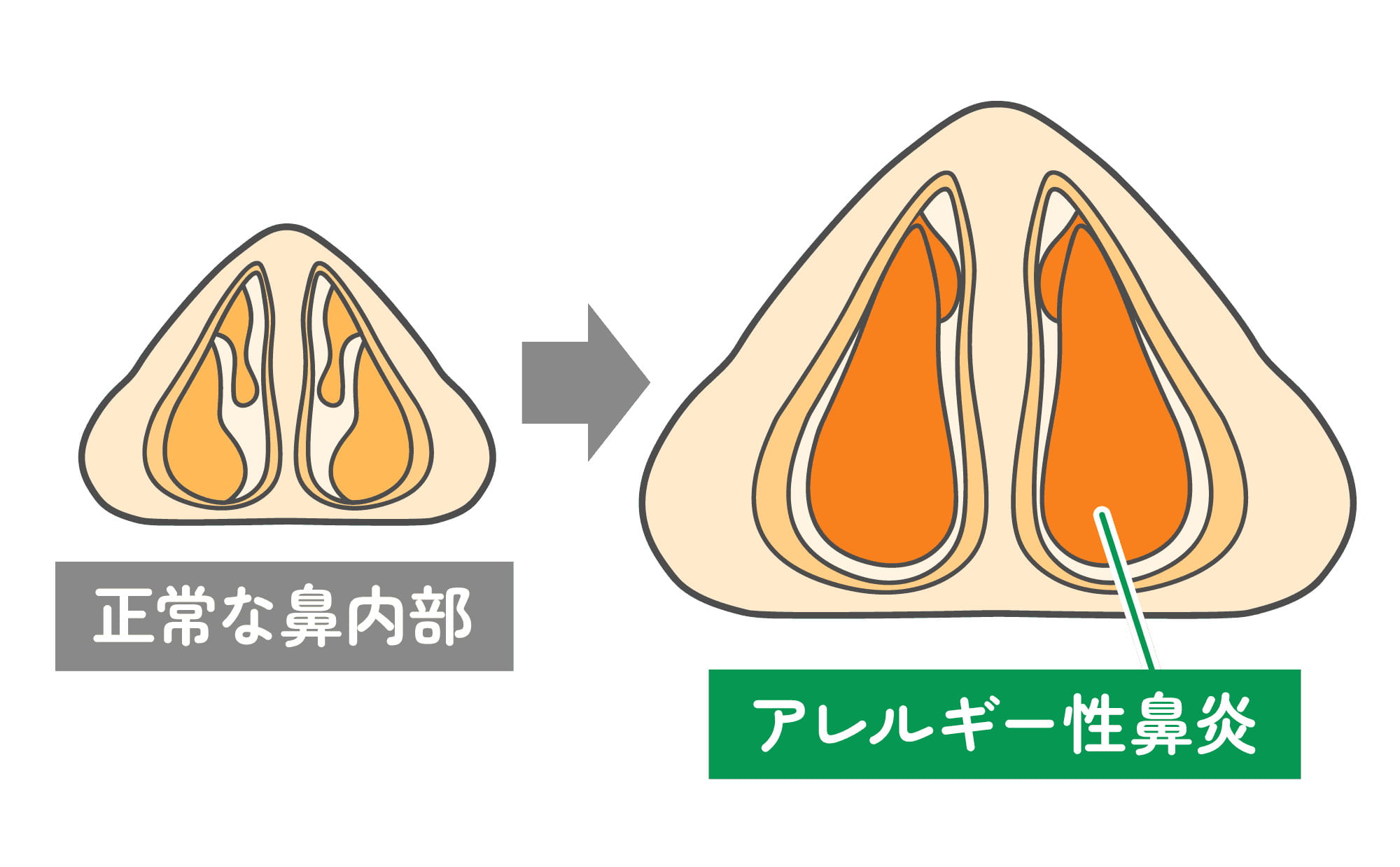 アレルギー性鼻炎（花粉症）に対する外的治療