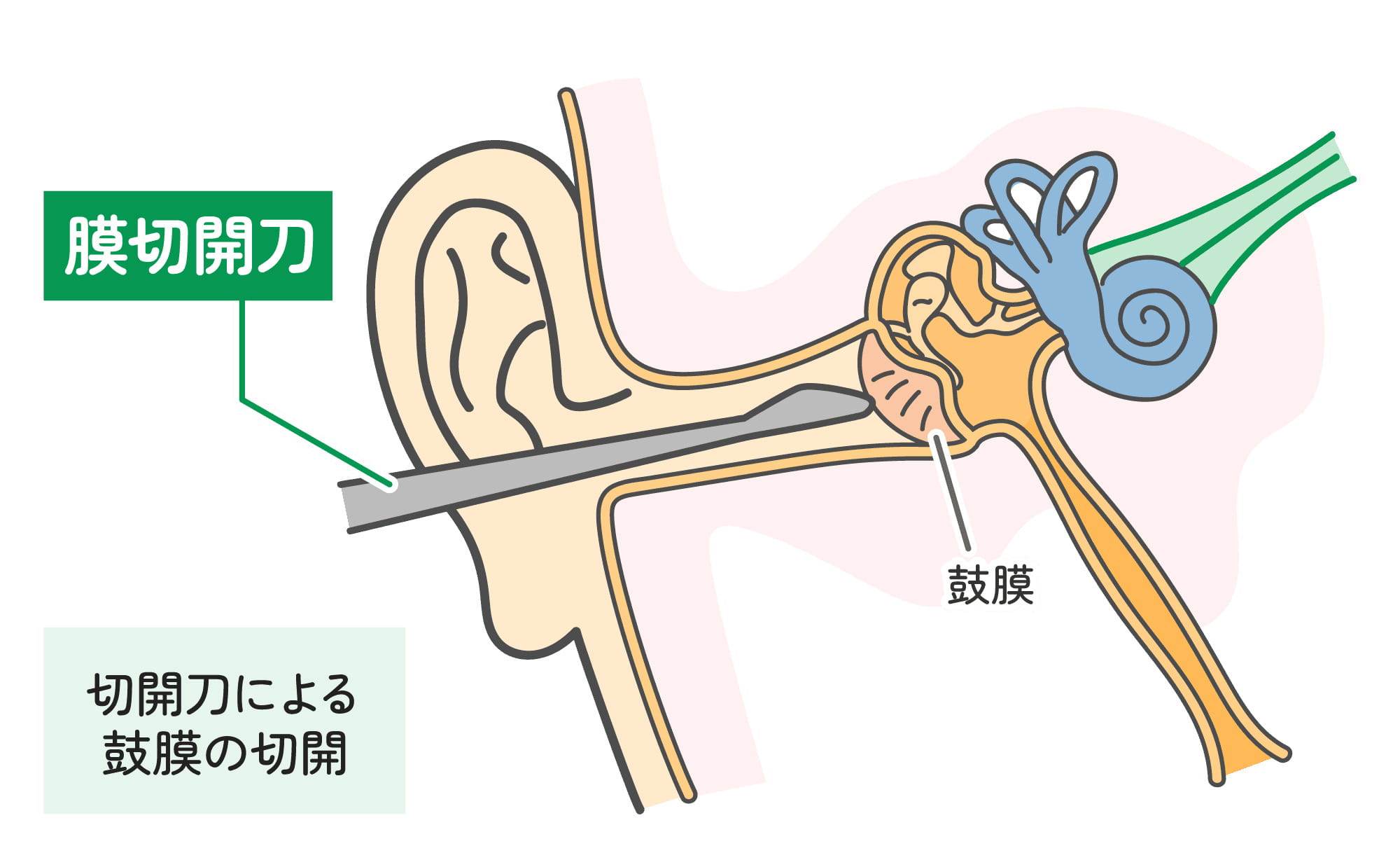 鼓膜切開術