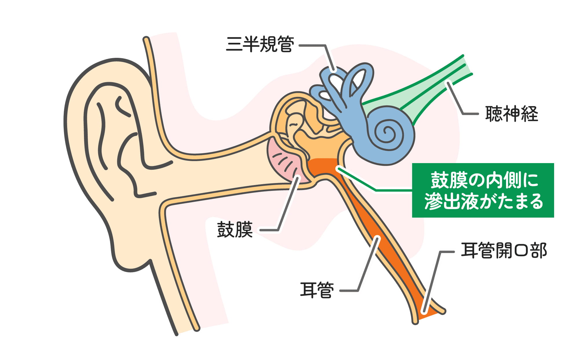 滲出性中耳炎とは