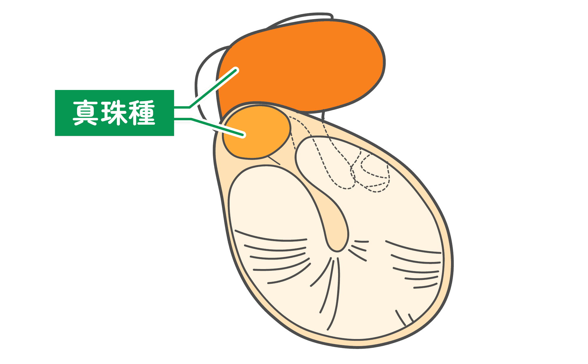 慢性中耳炎・真珠腫性中耳炎とは