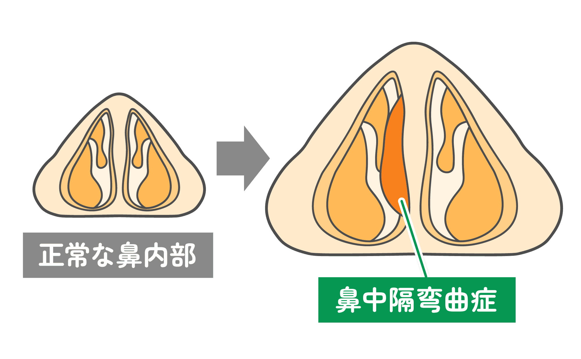 鼻中隔弯曲症とは