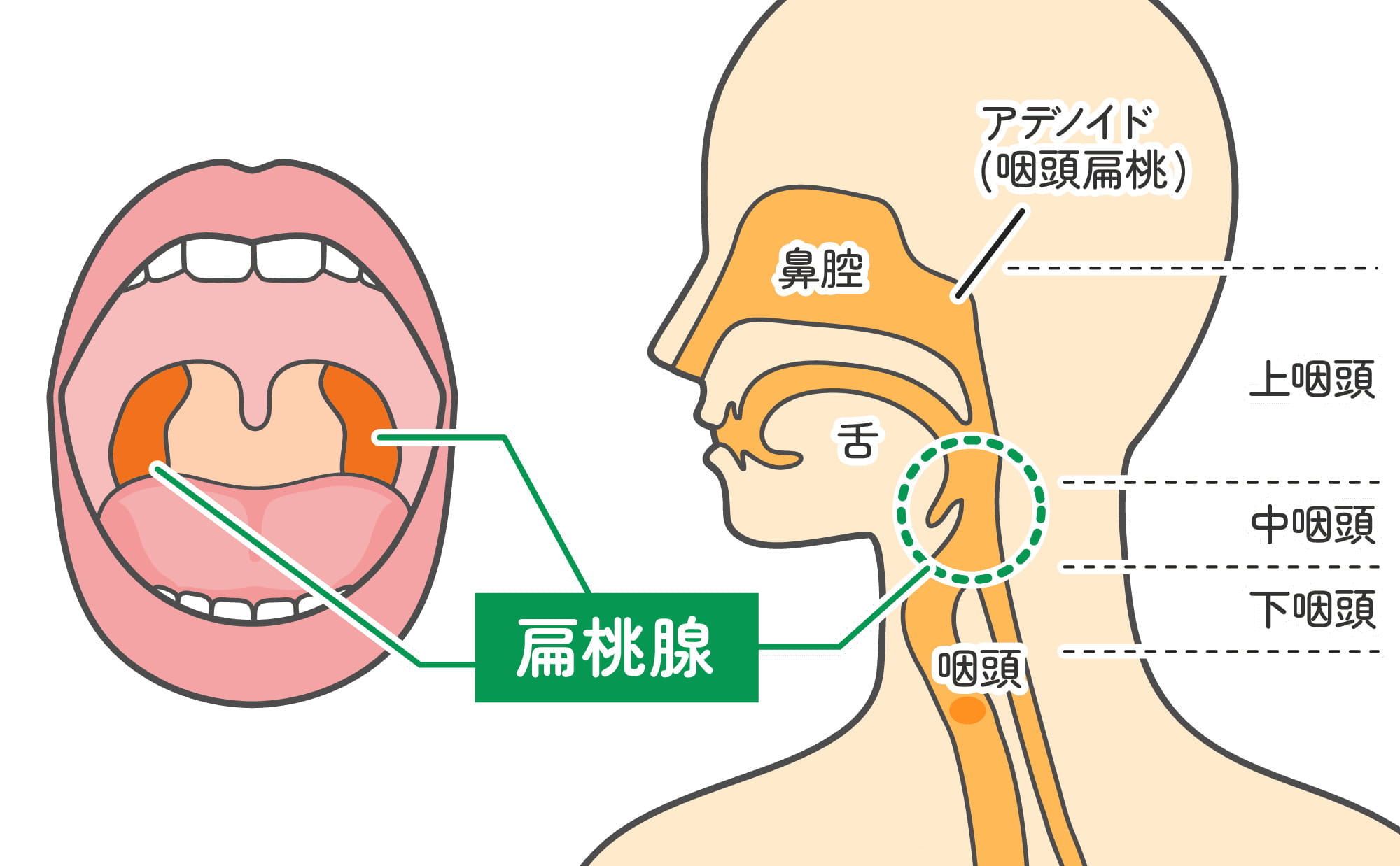 扁桃炎