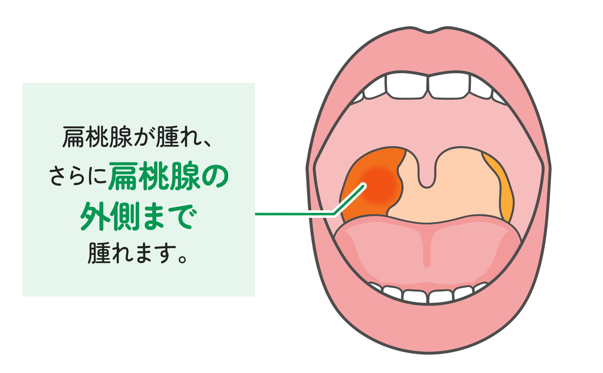 扁桃周囲膿瘍