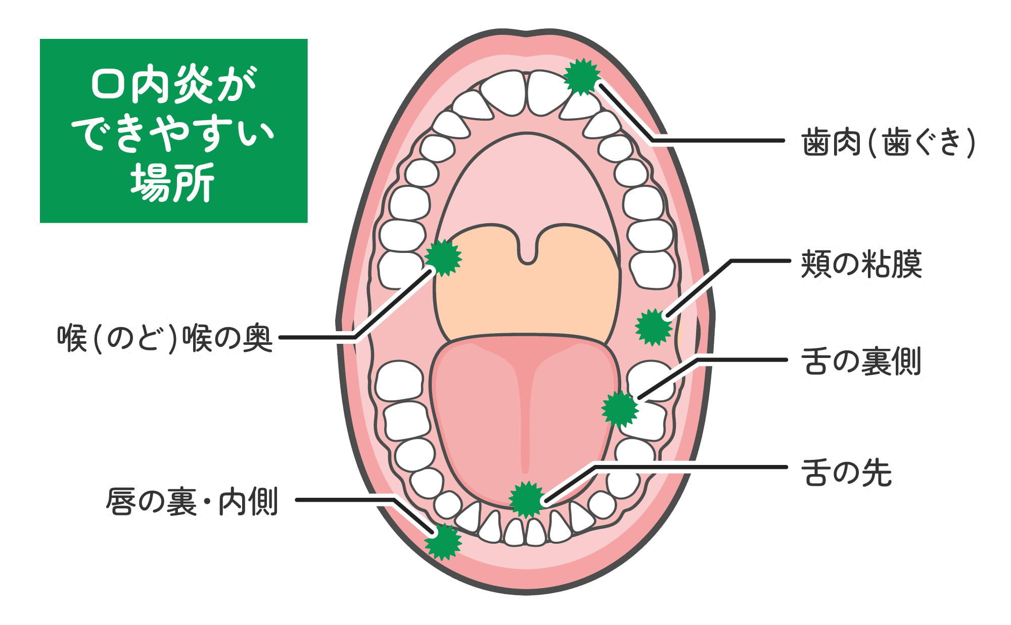 口内炎