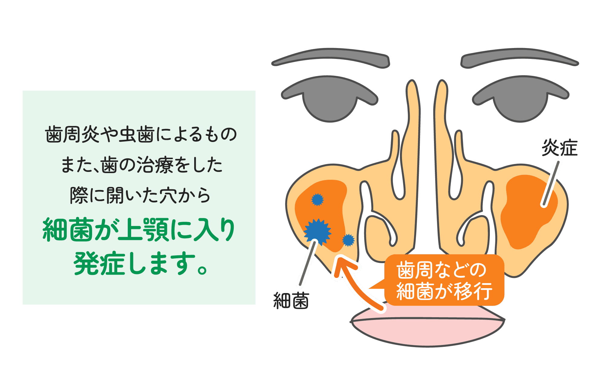 上顎洞炎とは